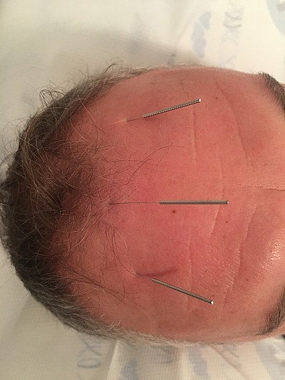 scalp