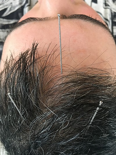 scalp