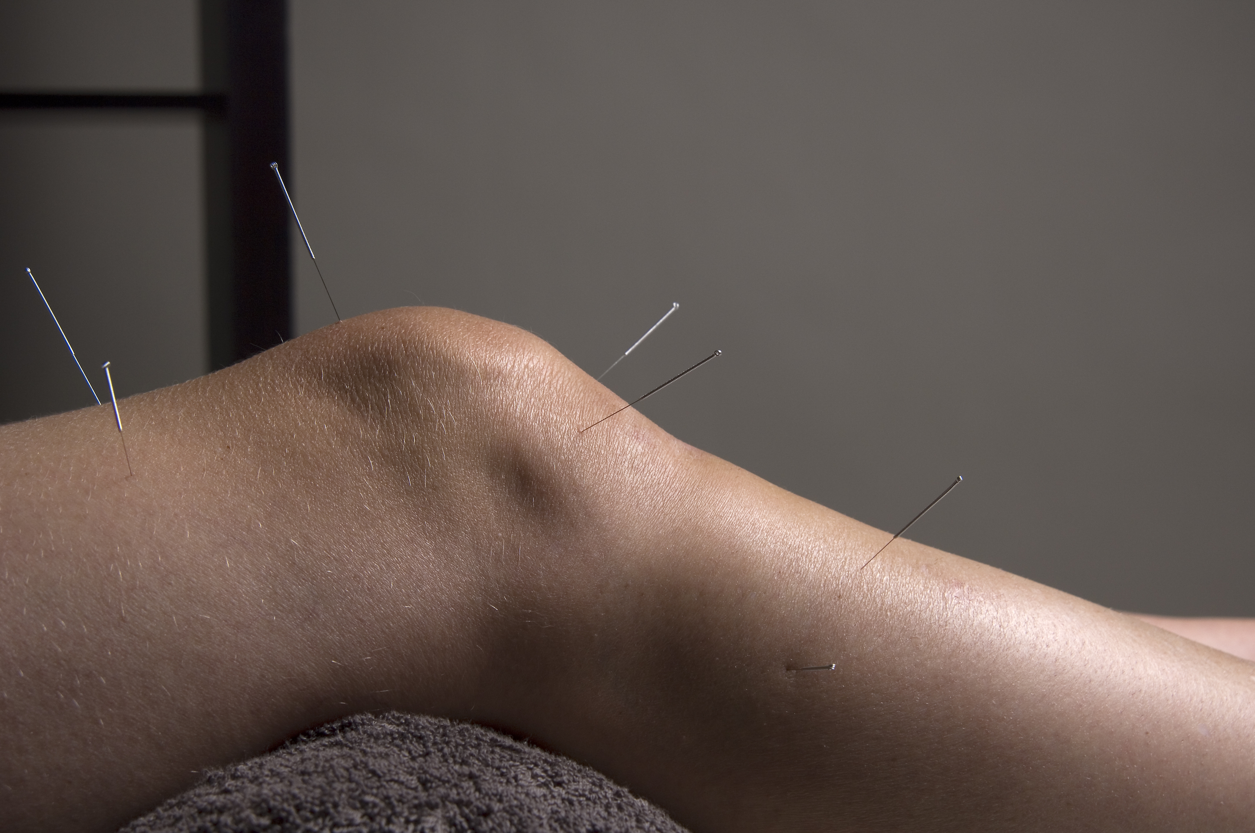 Acupuncture