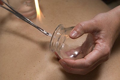 Cupping